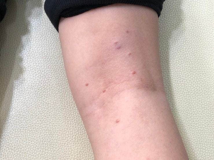  한약으로 물사마귀를 치료할 때 전형적인 모양 변화 (광주 순천 여수 광양 사마귀 아이앤맘 한의원) 