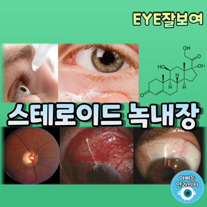  [EYE잘보여] 스테로이드 유발 녹내장