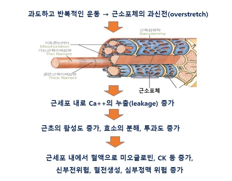  횡문근융해증 Rhabdomyolysis 이란? 콜라색소변, 뇨중 미오글로빈, 혈중 크레아틴키나제(CK)