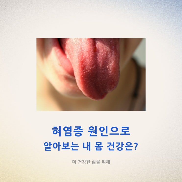 혀염증 원인으로 알아보는 내 몸 건강은?