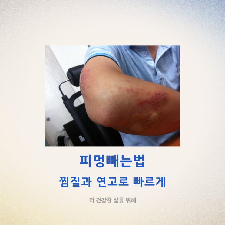  피멍빼는법 찜질과 연고로 빠르게