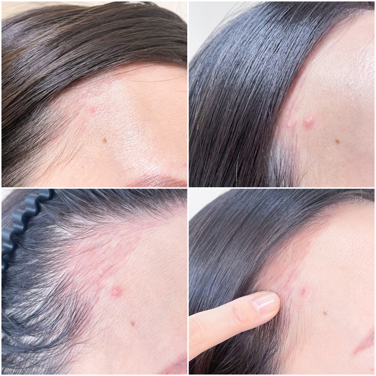 성인 이마에 뾰루지 트러블 여드름 원인 없애는 방법 성인 이마에 뾰루지 트러블 여드름 원인 없애는 방법