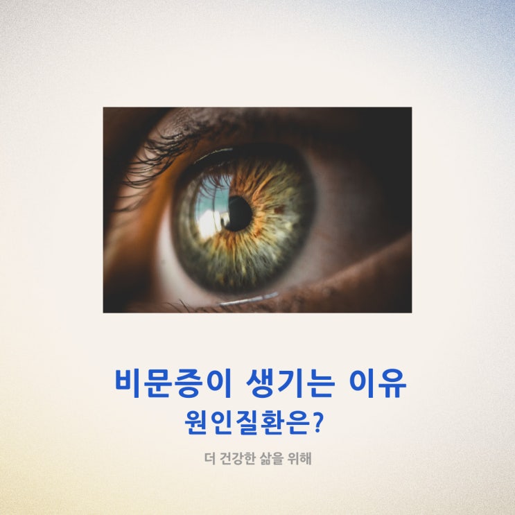  비문증이 생기는 이유와 원인 질환은?