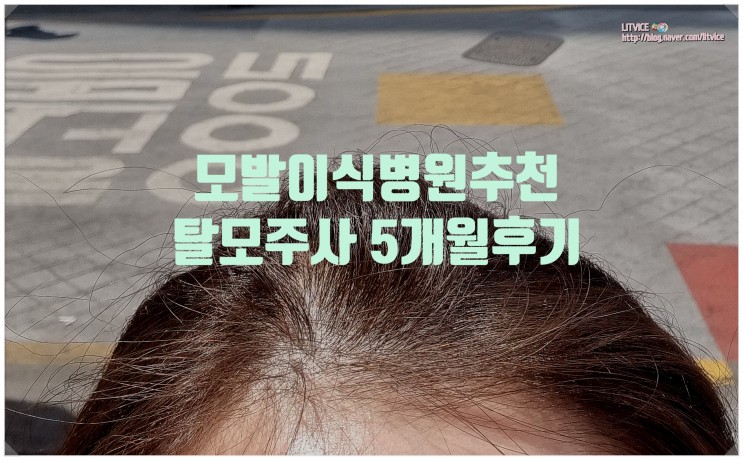 강남 모발이식병원추천! 메조테라피 탈모주사 5개월 후기