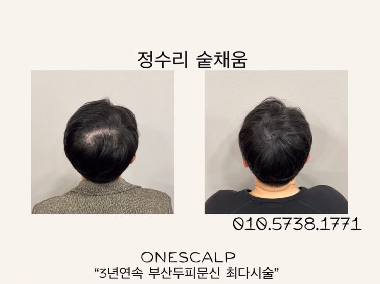  부산남자두피문신 탈모에도 자신있게