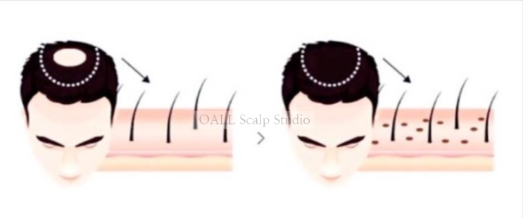  [OALL Scalp studio] SMP 두피문신 ?!