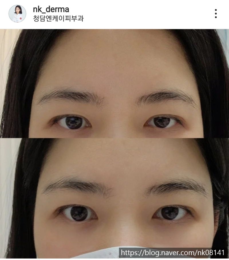마곡동 슈링크 유니버스 동안 페이스 피부과 최신 리프팅 (+효과, 부작용, 가격정보) 4