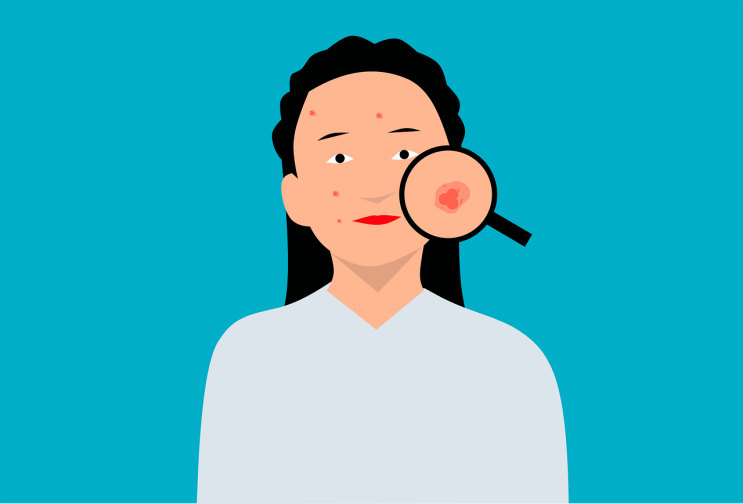  사춘기 여드름과 빠른 초경과 성장 간의 관계. 그리고 여학생 성장 치료의 어려움.