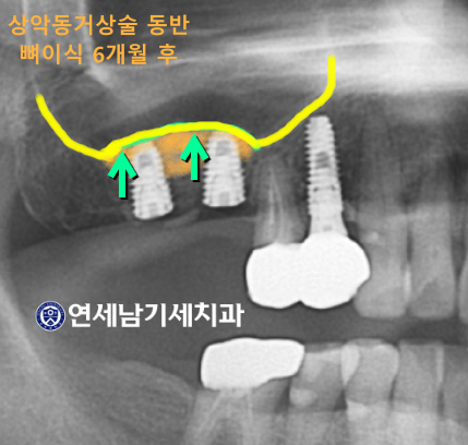 상악동거상술비용 알아보기 전에