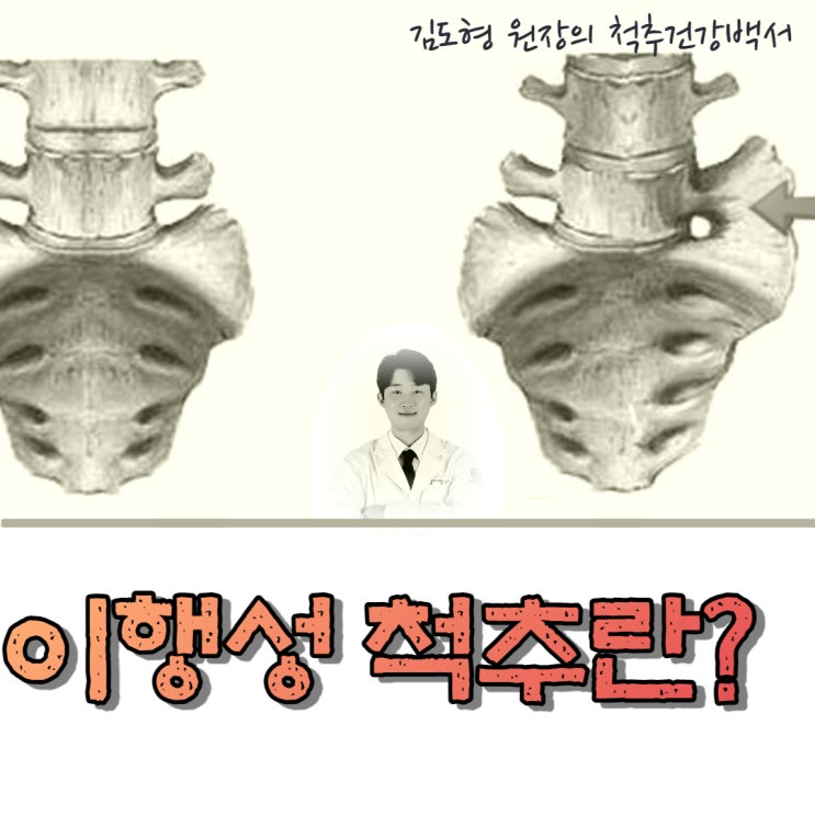 허리뼈가 6개라는데 괜찮나요? (천추의 요추화, 이행성 척추란...)