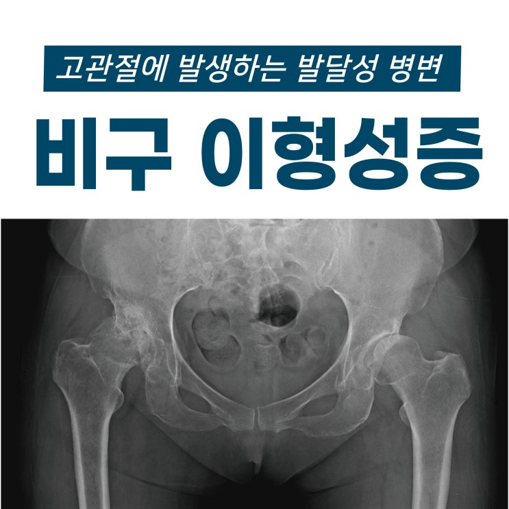  '비구 이형성증' 불안정한 보행과 고관절 탈구 유발, 치료는?