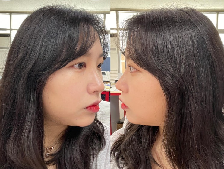  [미사역 피부과]아큐주사,윤곽주사로 이중턱,턱살 후기