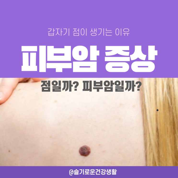 점이 생기는 이유 피부암 초기 증상 구분법