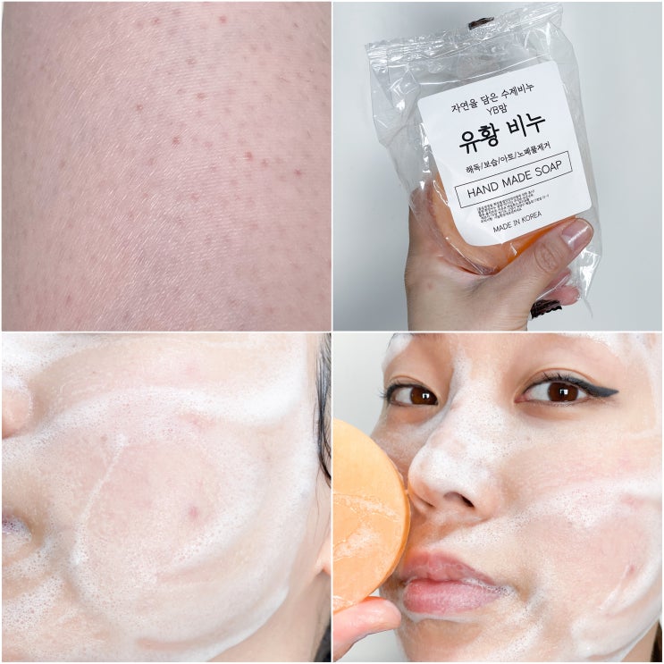 얼굴 모공 각화증 원인과 비누로 없애는법 얼굴 모공 각화증 원인과 비누로 없애는법