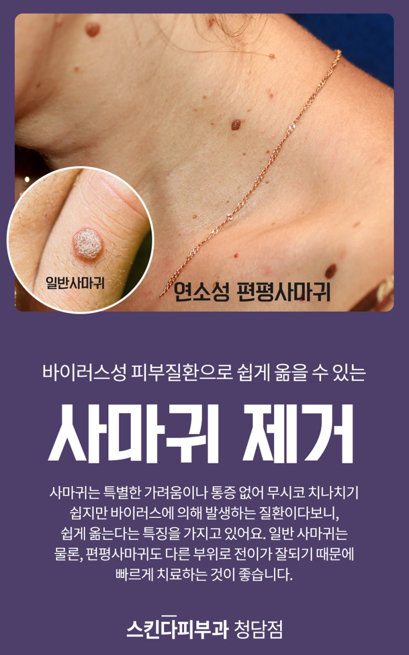 편평사마귀 피부과 치료의 초기 증상에 대해 알아보세요