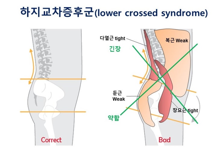  하지교차증후군 lower crossed syndrome 엉덩이기억상실증 gluteal amnesia, 골반경사와 요통