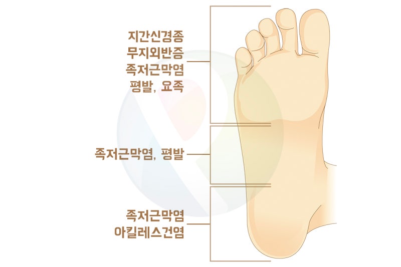 발바닥통증 부위별 발바닥 통증 지간신경종 족저근막염 아킬레스건염 무지외반증 - a2 발바닥통증 부위별 발바닥 통증 지간신경종 족저근막염 아킬레스건염 무지외반증 - A2