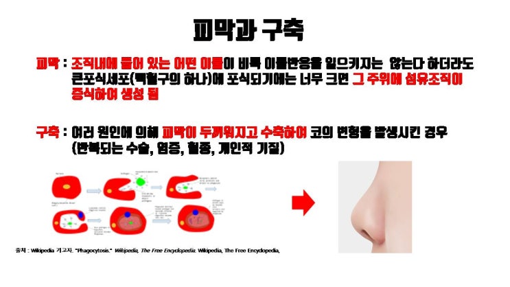  코수술 염증으로 코실리콘 제거 후 구축코 발생을 줄이려면?