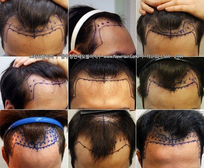헤어 이식 비용의 디자인 요소를 보고