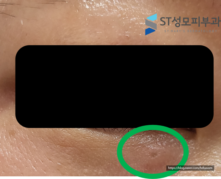  피부과전문의가 직접 아이써마지 받은 후기, 알아둘 점 (써마지 후 물집, 딱지) - 삼성동 피부과 닥터림
