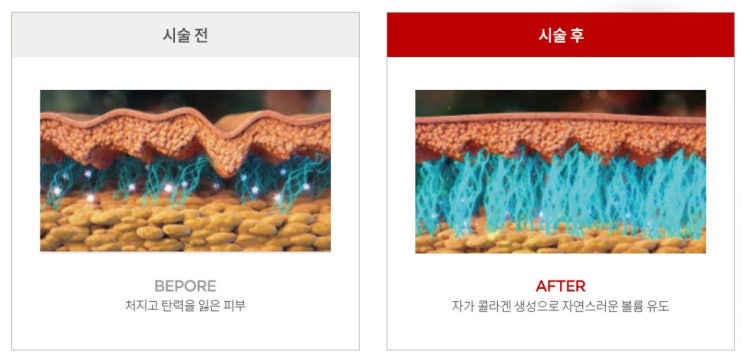  콜라겐주사 울트라콜 필러보다 좋은이유 PDO 스킨부스터