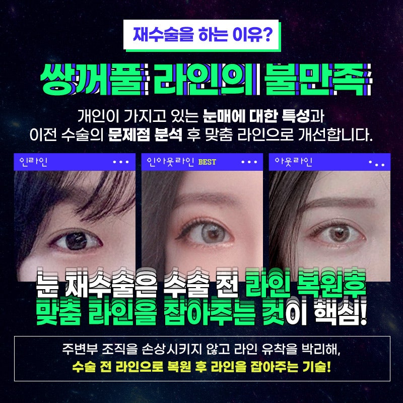 부산에서 쌍꺼풀 수술을 하는 이유를 알아보세요