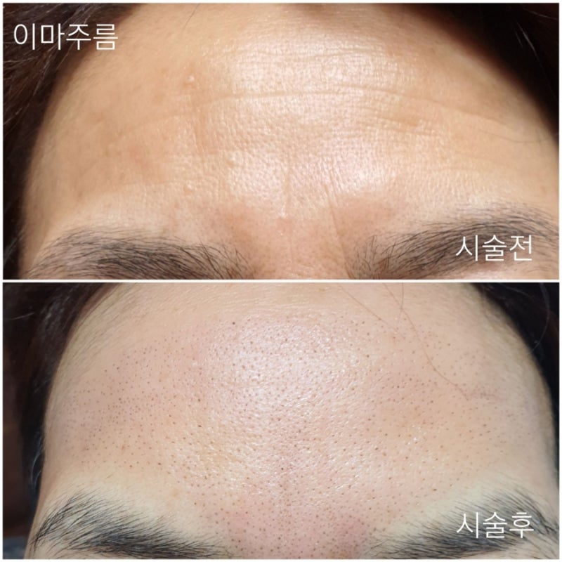 플라즈마 블라스트 콧날 옆주름 1-2일차(안쪽둘레) 5