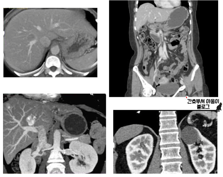 검사, NPO 및 동의서 여부 1 - APCT, Chest CT,CT 3D Aorta : 네이버 블로그