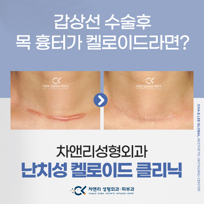  목 흉터, 갑상선수술 후 켈로이드흉터로 남았다면