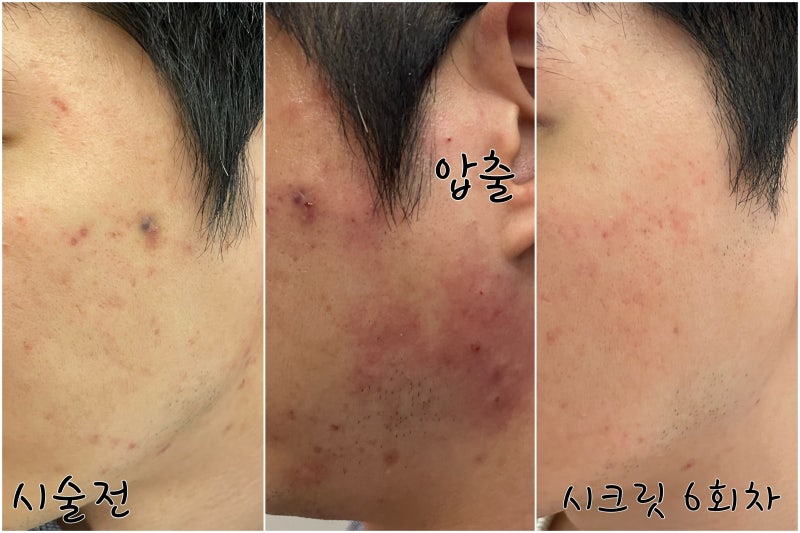 남성 턱수염탈모레이저 5회차/EXO좀주사,여드름피부흉터관리시크릿rf레이저 2