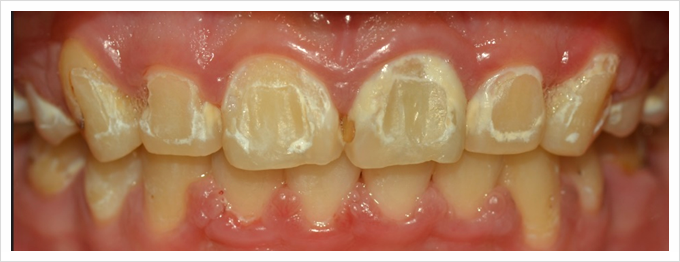 응암역치과&lt; 변색된 치아를 삭제 없이 보존적 치료로 살리는 방법!&gt;