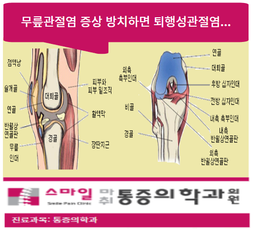  [일산무릎병원] 무릎관절염증상 ..방치하면 퇴행성관절염까지!