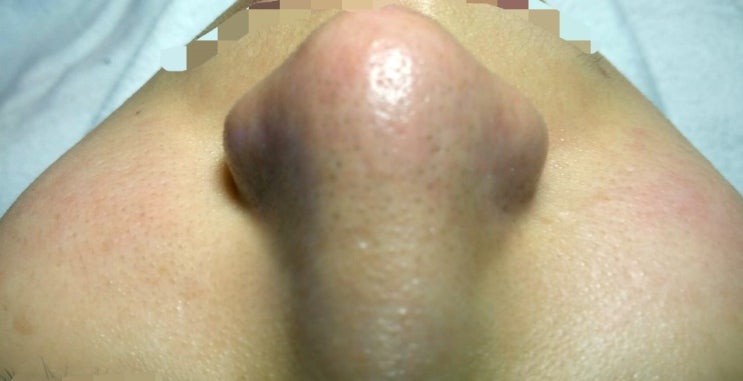  피부를 깨끗하게 만드는 모공관리