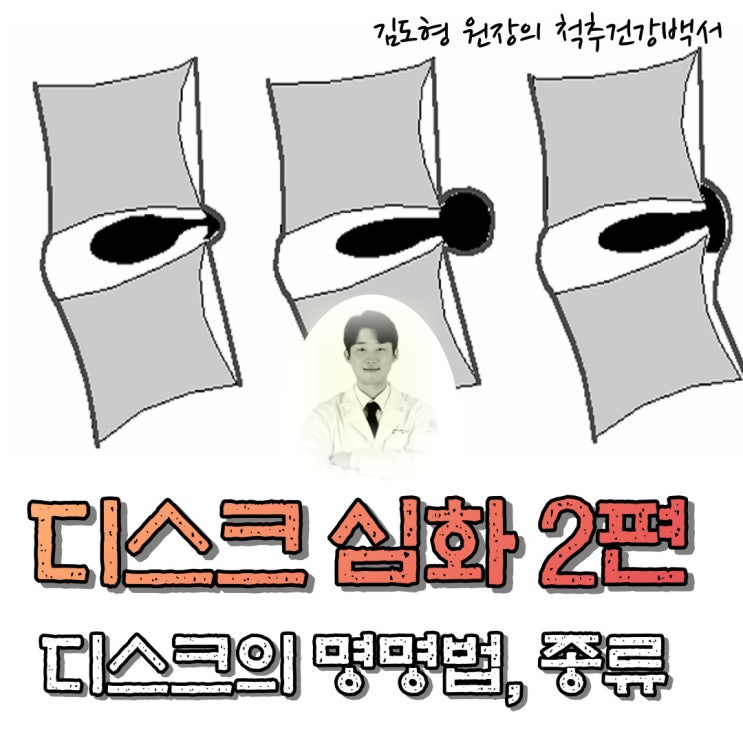  디스크 심화 2편. 디스크의 타입, 명명법 (HIVD nomenclature)