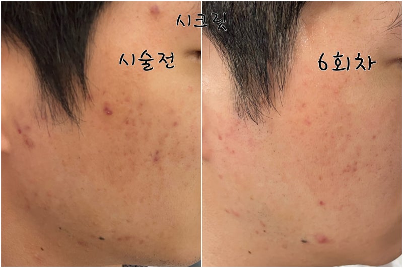 남성 턱수염탈모레이저 5회차/EXO좀주사,여드름피부흉터관리시크릿rf레이저 3