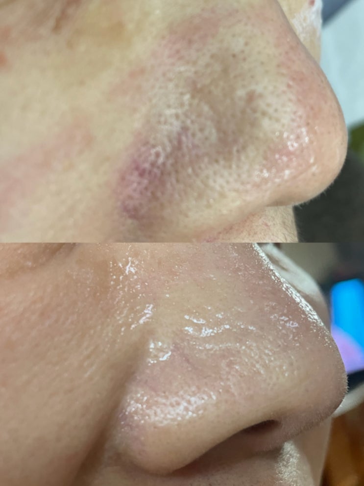  [대구피부관리 아미뷰티] 모공이보였던 주사코 콜드플라즈마로 관리 재생 모공지우개가 따로없네요