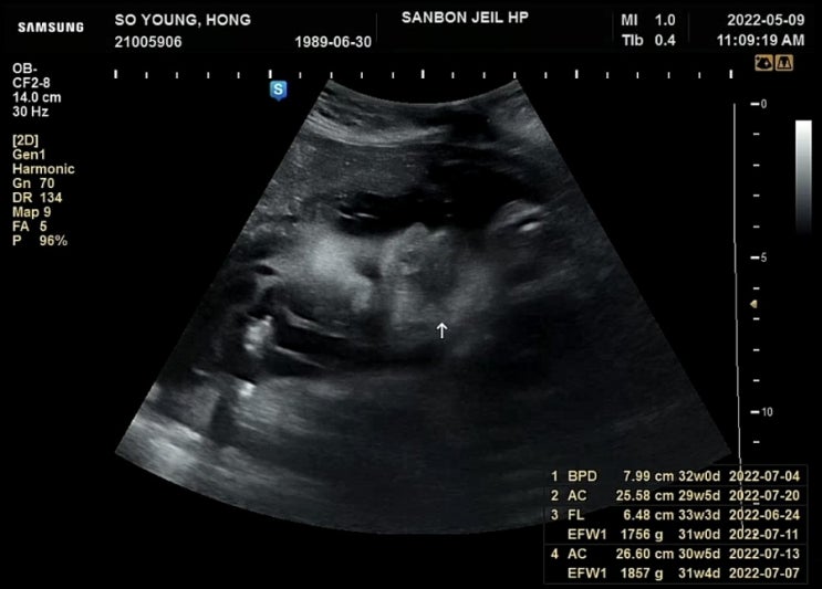임신 33주 1일, 여전히 역으로 있는 아가 & 조금 이르게 받은 막달검사