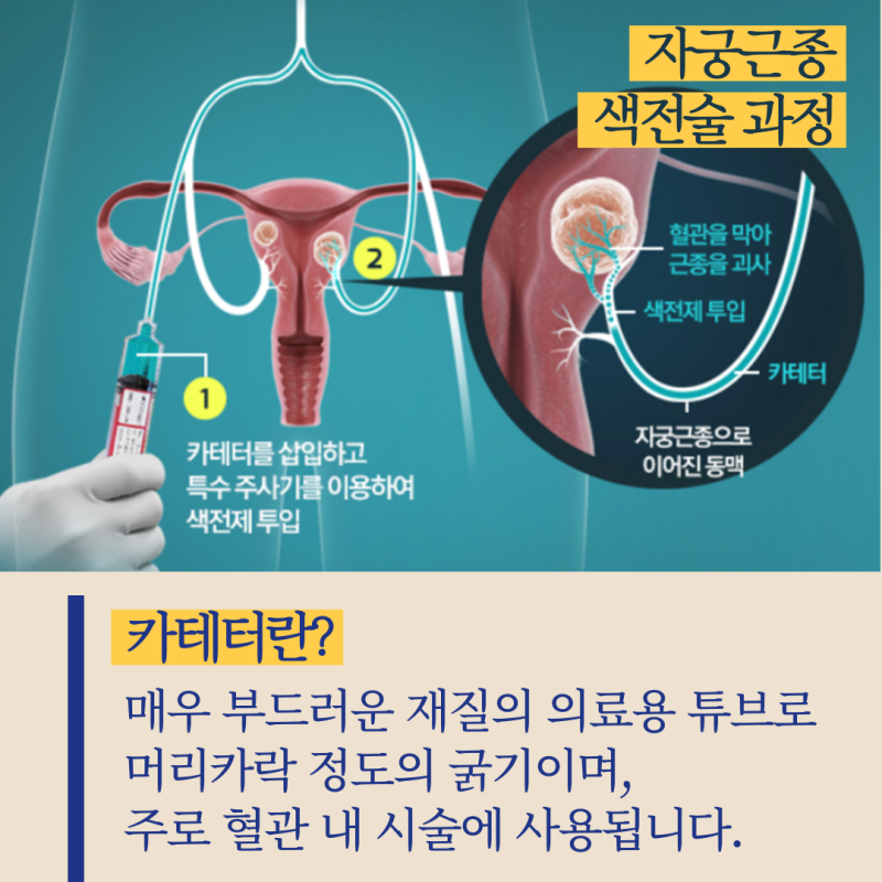 1년만에 자궁근종색전술(Uterine Fibroid Embolization) 시술을 받다..