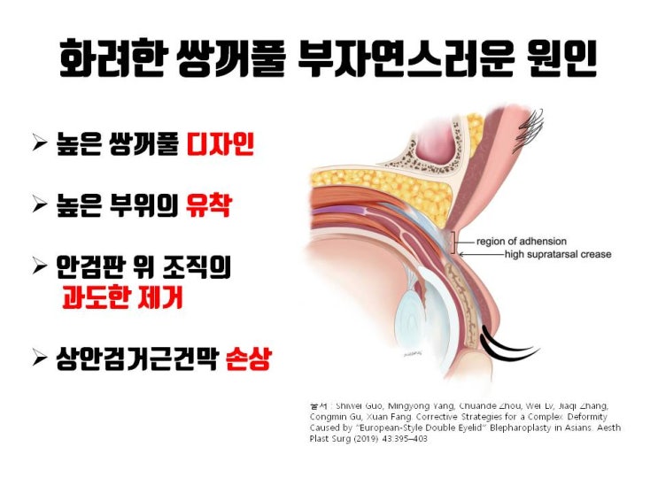  지나치게 화려한 쌍꺼풀로 인해 부담스러운 경우 눈재수술 전략!!!!