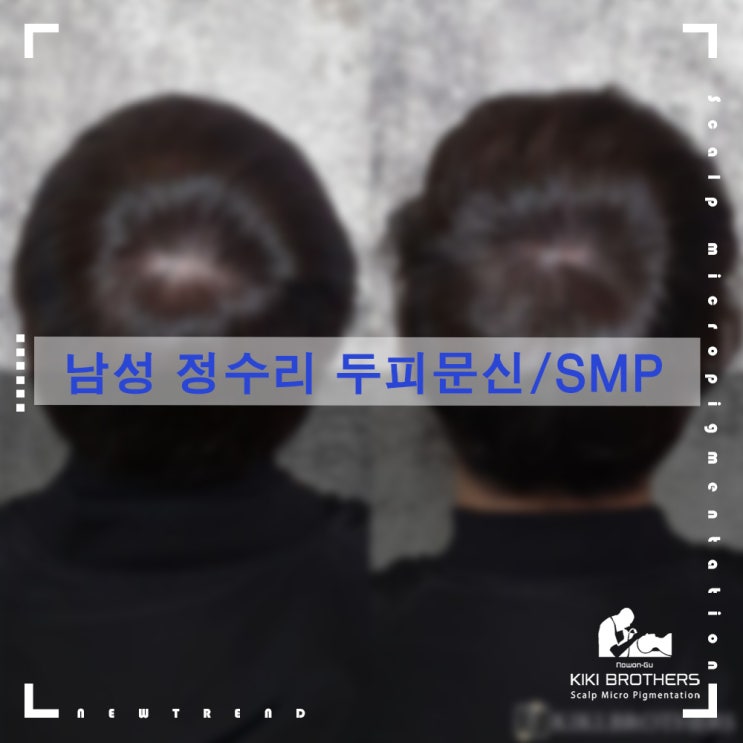  도봉두피문신, 남성 정수리탈모 극복!! 탈모커버 전문점 두피문신/SMP 전문샵 키키브라더스 노원
