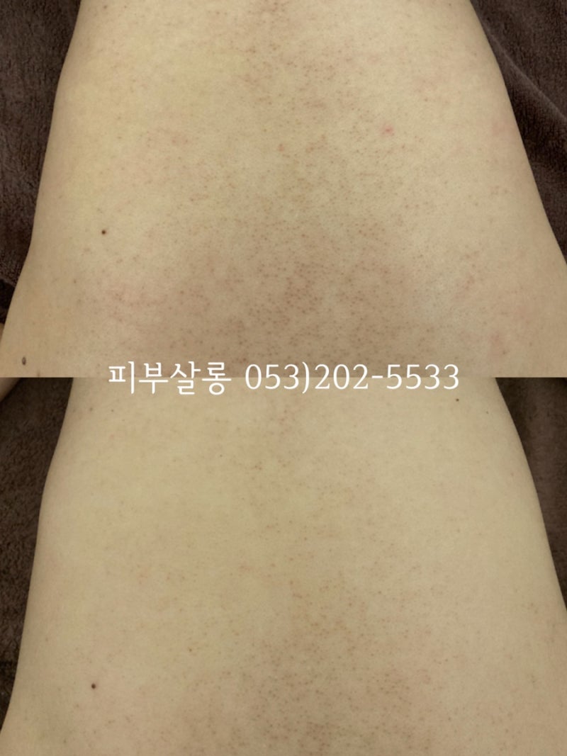 대구피부관리실)달서구 알라딘필링팔여드름자국재생케어리뷰/죽전동피부관리실 4