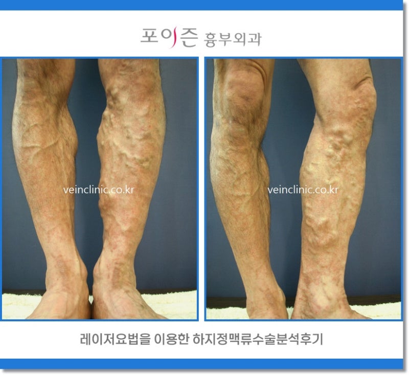 하지정맥류의 초기 증상, 원인, 수술비용보험에서 보장되기 전에 알아야 할 것은?