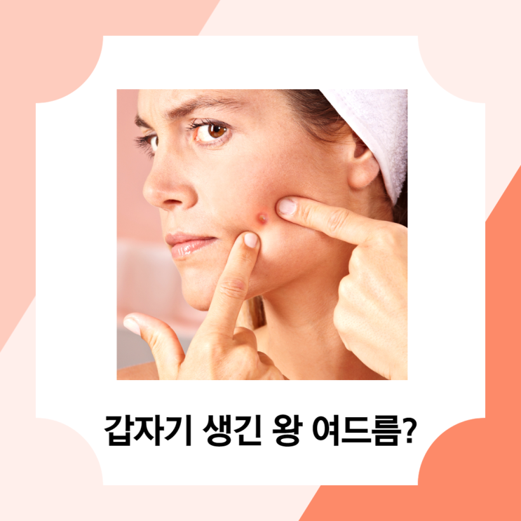 갑자기 생긴 왕 여드름 짜도 될까? 원인, 관리 방법까지 갑자기 생긴 왕 여드름 짜도 될까? 원인, 관리 방법까지