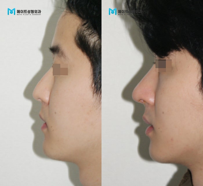 남자 코수술 전후 후기( 무보형물, 복코교정 : 네이버 블로그 남자 코수술 전후 후기( 무보형물, 복코교정 : 네이버 블로그
