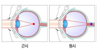  원시, 근시, 난시에 대해 정확하고 빠르게 이해해보자(난시안이 방사선시표가 진하게 보이는 이유)