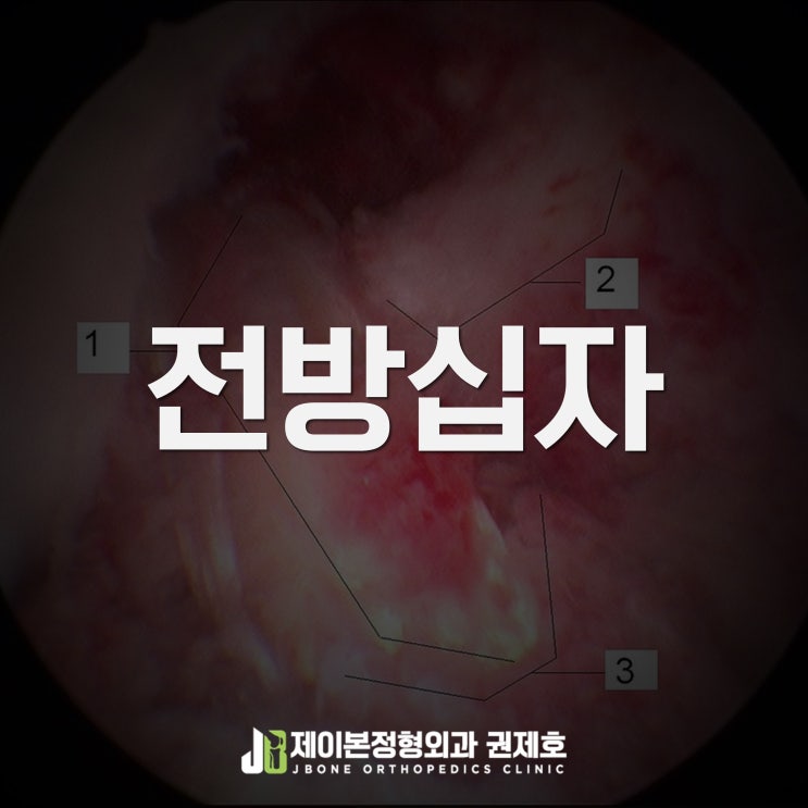  전방십자인대재건수술 reconstruction 끊어진 인대를 어떻게
