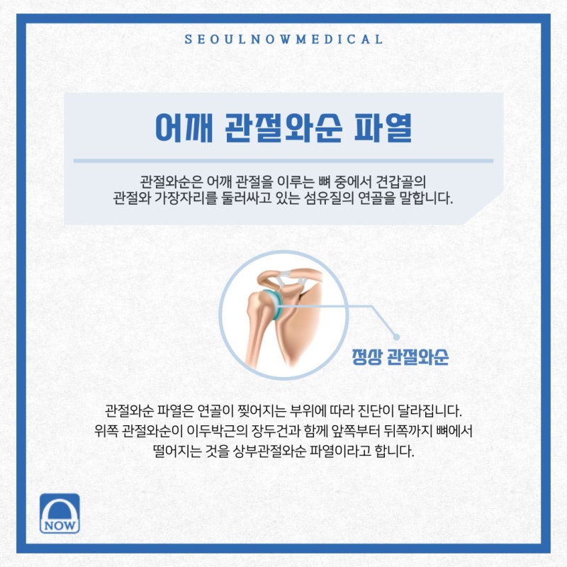 강릉정형외과 어깨관절와순파열 특징은? 4