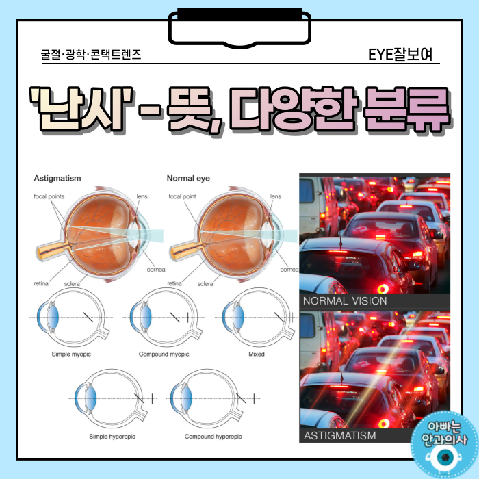  난시의 뜻과 종류, 안경처방전 읽기