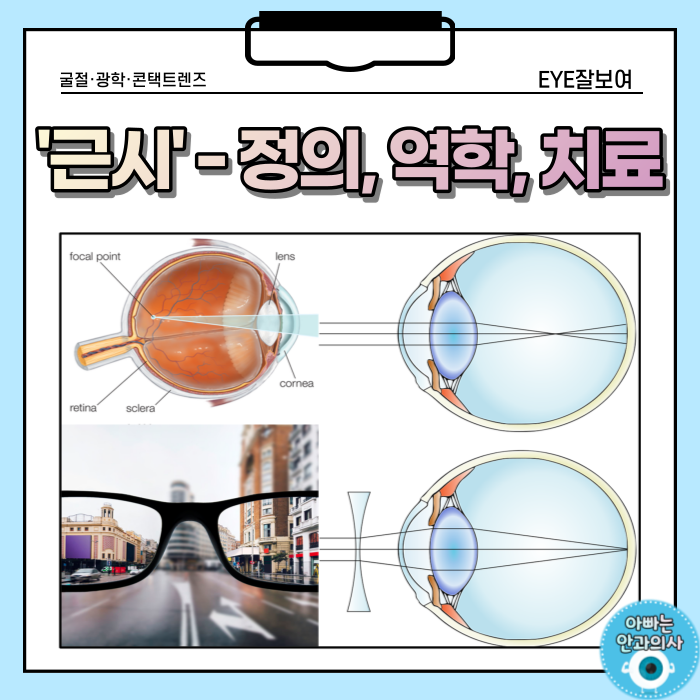  근시, 얼마나 아세요?