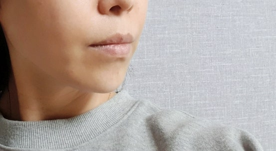 브이로리프팅 효과 /턱선굴곡 심부볼리프팅 탄력레이저